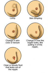 En_Breast_cancer_illustrations